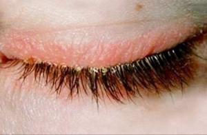 Блефарит — что это такое?