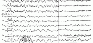 Электроэнцефалография при опухолях головного мозга